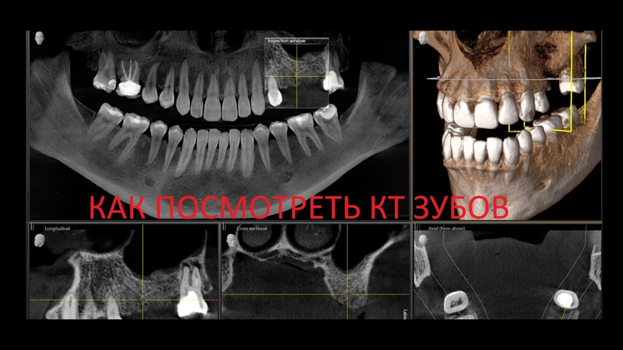 Узнайте как просматривать КТ зубов дома. Программы для просмотра КТ и МРТ.  Формат DICOM