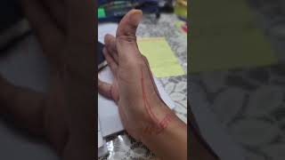 *Anatomical Snuffbox* || MBBS || Post Grad