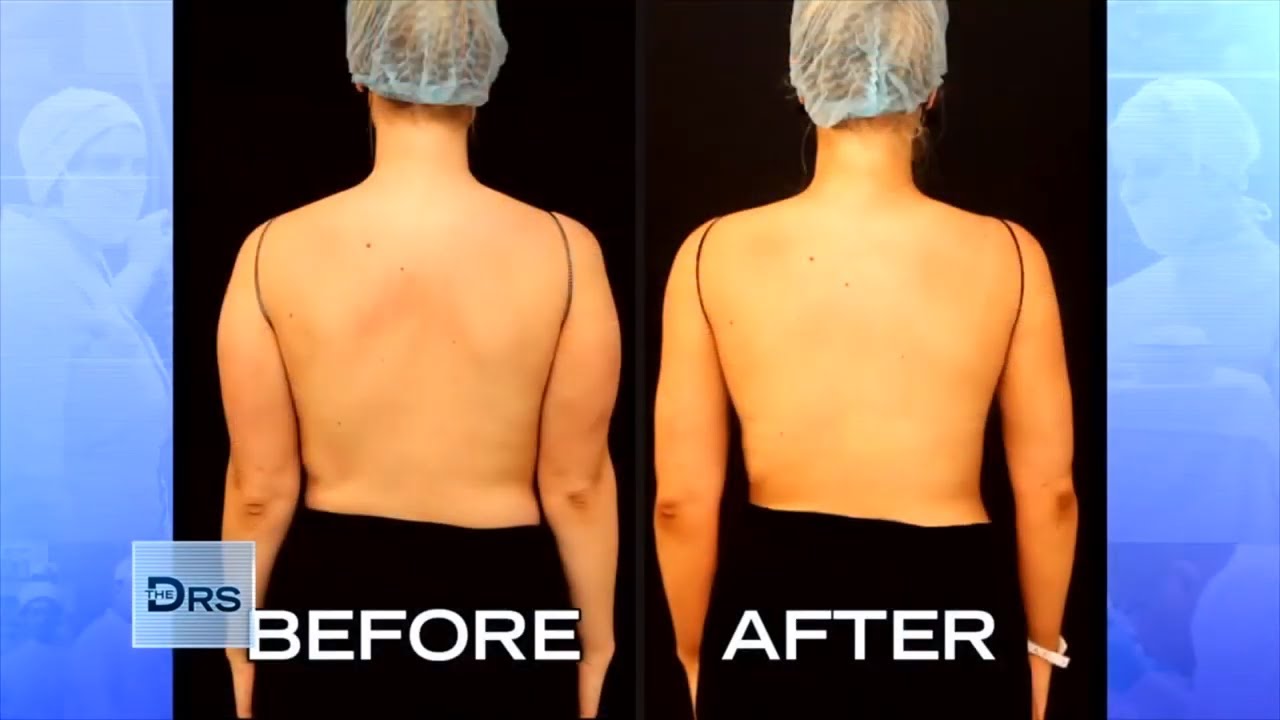 Fight the Bat Wing: How Laser Lipo Can Slim Your Arms - Vargas