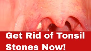 How to Get Rid of Tonsil Stones – Uncover the Secrets