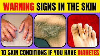 10 Skin WARNING SIGNS of Diabetes that You Didnt Know!| Doc Cherry (English)