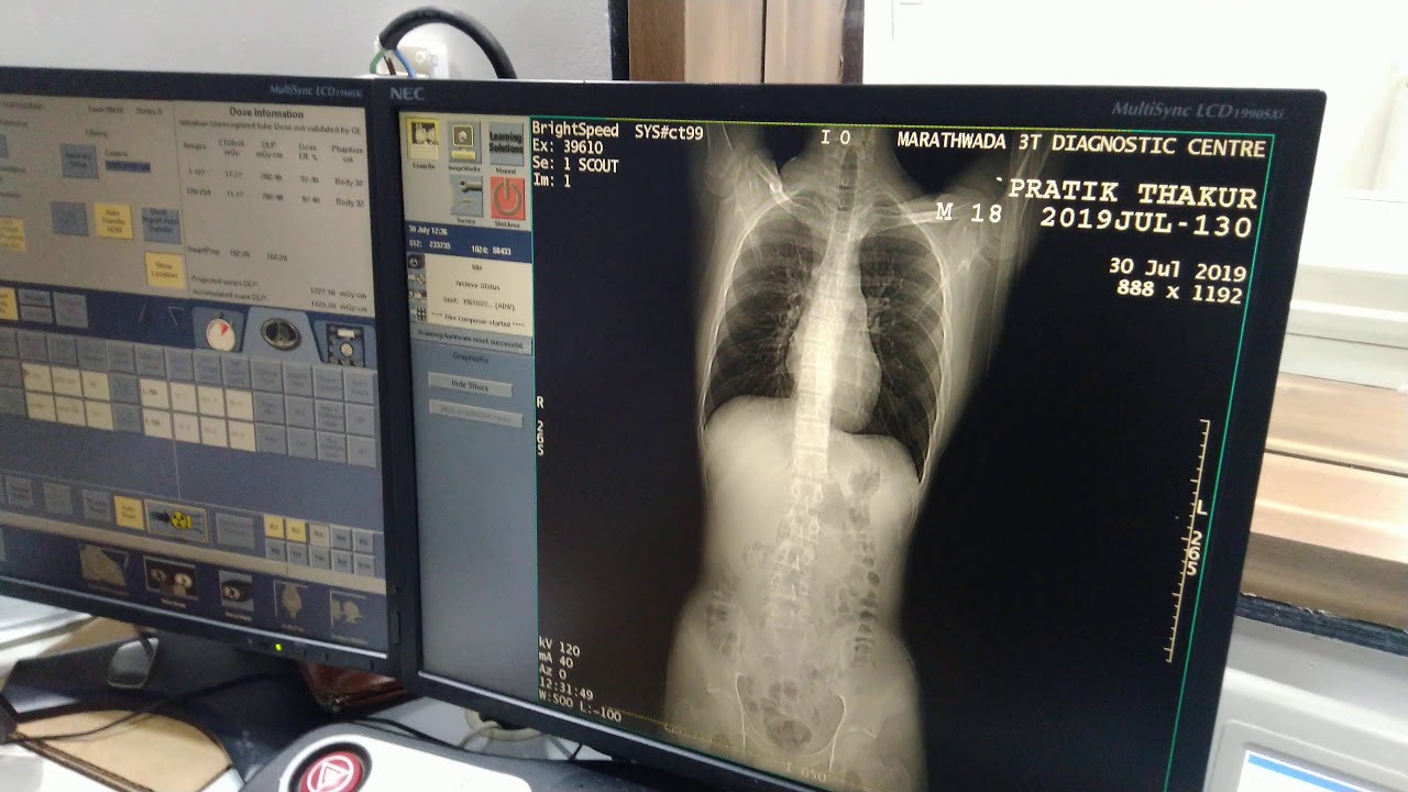 CT AORTOGRAM SIMPLE TRICKS - YouTube