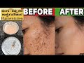 ಭಂಗು ಕಪ್ಪು ಕಲೆ ಶಾಶ್ವತ ಪರಿಹಾರ  | Pigmentation home remedy