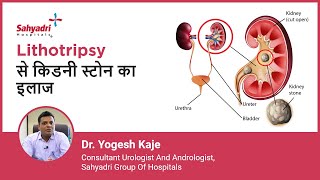 Lithotripsy से किडनी स्टोन का इलाज | Lithotripsy for Kidney Stones | Dr Yogesh Kaje, Sahyadri screenshot 5