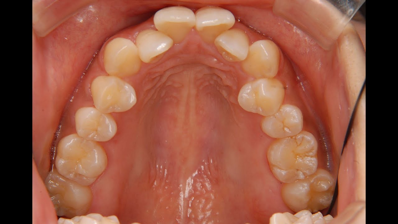 症例30】歯がガタガタだった30代女性の表側ワイヤー矯正u0026抜歯症例