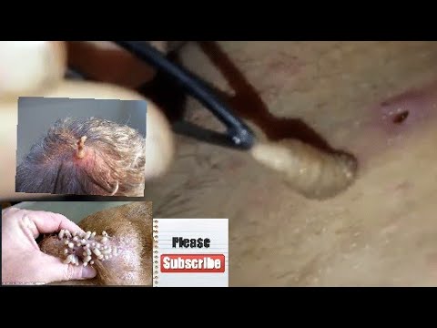 Remove Botfly Larva in Human Body