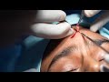 Forehead Scar Removal Surgery - Dr. Sunil Richardson