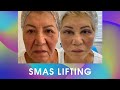 Операционный smas лифтинг. Подтяжка лица. Блефаропластика