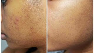 Skincare Routine | Fading Acne Scars and Reducing Pimples | JourneyToWaistLength