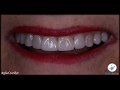 Composite Veneers