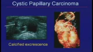 Thyroid Nodules Sonographic Evaluation and Biopsy Recommendations