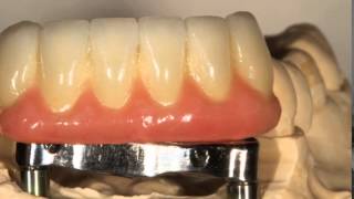 Telescopic Bar Implants by LSK121