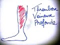 Smartneasy  thrombose veineuse profonde  dr astuce