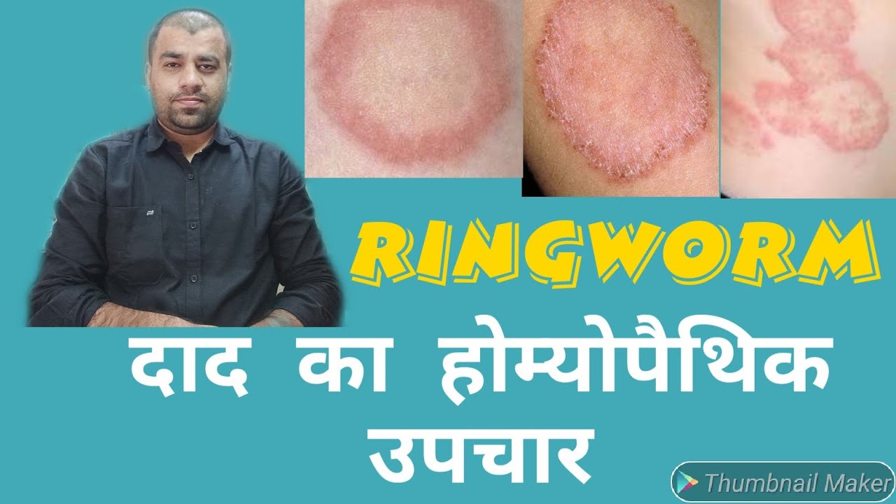 Ringworm Fungal infection homeopathic medicine daad ka homeopathic