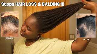 Use This Once a Week and Your Hair Will Never Stop Growing| DIY for HAIR LOSS & BALDING‼