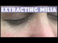 Extracting a Milia under the eye