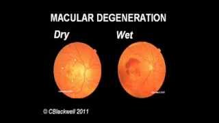 Macular Degeneration 2013 Update