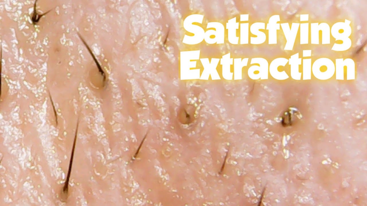 Satisfying Extraction ShortVideoNose YouTube