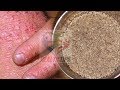 skin allergy treatment in hindi - चुटकियों में skin allergy को दूर करने का जबरदस्त का घरेलू नुस्खा