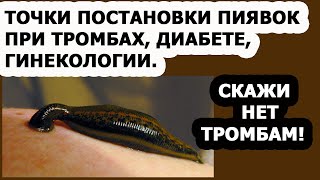 Гирудотерапия точки постановки пиявок при различных заболеваниях