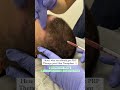 Prp treatment  post hair transplant technique shorts shortsfeed medlinks