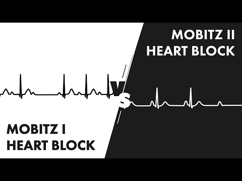 Vídeo: Heart Block (Mobitz Tipus I) En Gossos