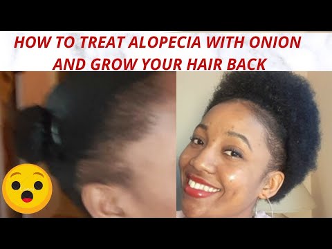 I HAD ALOPECIA BUT MY ONION JUICE RECIPE FOR HAIR GROWTH WILL SHOCK YOU