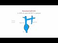 Persistent Left Superior Vena Cava (Left SVC) | Embryology and Clinical Anatomy