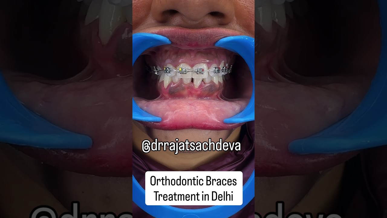 Braces Treatment in Delhi by Dr Rajat Sachdeva – expert orthodontic care for teens and adults.