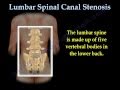 Lumbar Spinal Canal Stenosis, lowback pain - Everything You Need To Know - Dr. Nabil Ebraheim