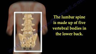 Lumbar Spinal Canal Stenosis, lowback pain - Everything You Need To Know - Dr. Nabil Ebraheim