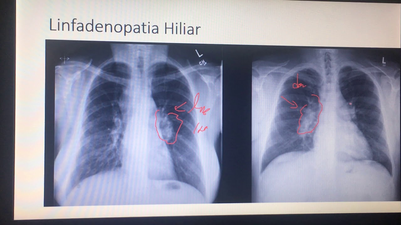 Lección 17. Linfadenopatia Hiliar. Signo Superposiciones Hilio. Radiografía Torax