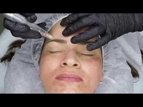 ¿Qué es y cómo funciona el microneedling?