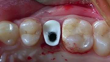 Cervico System in Action - Clinical case by Dr. Ioannis Vergoullis