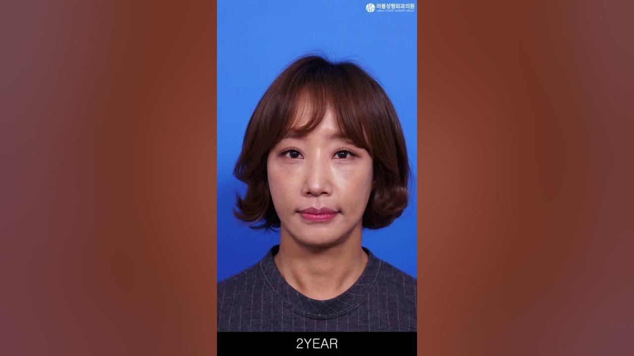 안면목거상&이마거상 수술전부터 2년차까지 후기✨ - Youtube