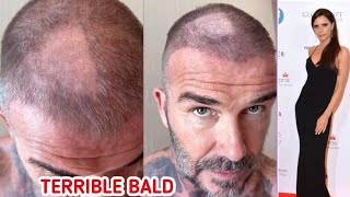 David Beckhams Diy Buzz-Cut Fail Bald Patch Shocks Fans Victoria Calls It Terrible
