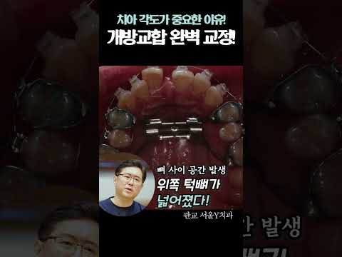 ???? 치아 각도가 중요한 이유!