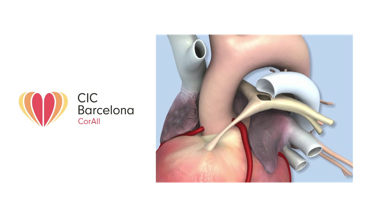 Atresia Pulmonar American Stroke Association - vrogue.co