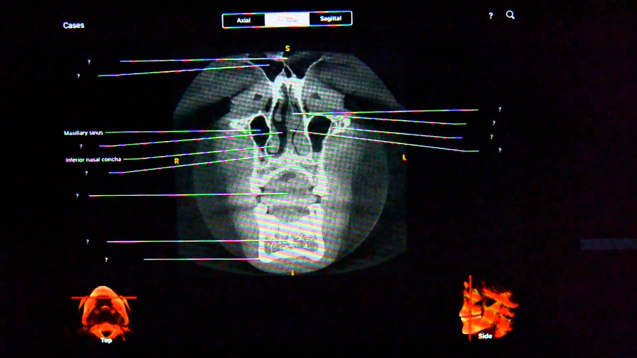 CBCT atlas app for iOS quick overview - YouTube