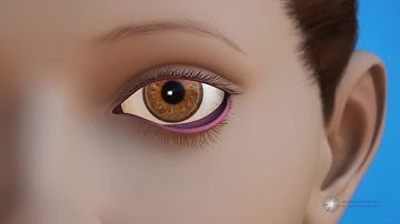 What are entropion and ectropion?