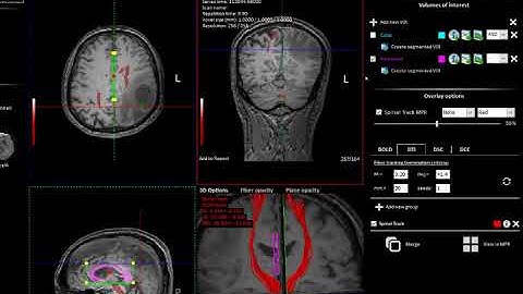 nordicBrainEx v2.3 CreatingFiberGroups & Export to Navigation