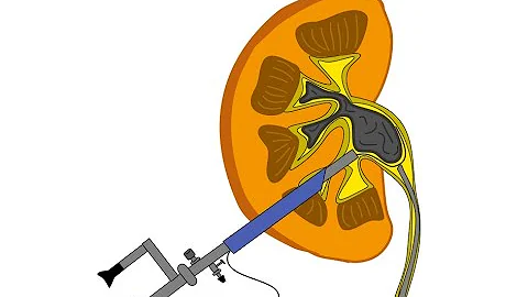 Che cos'è la litotrissia percutanea?