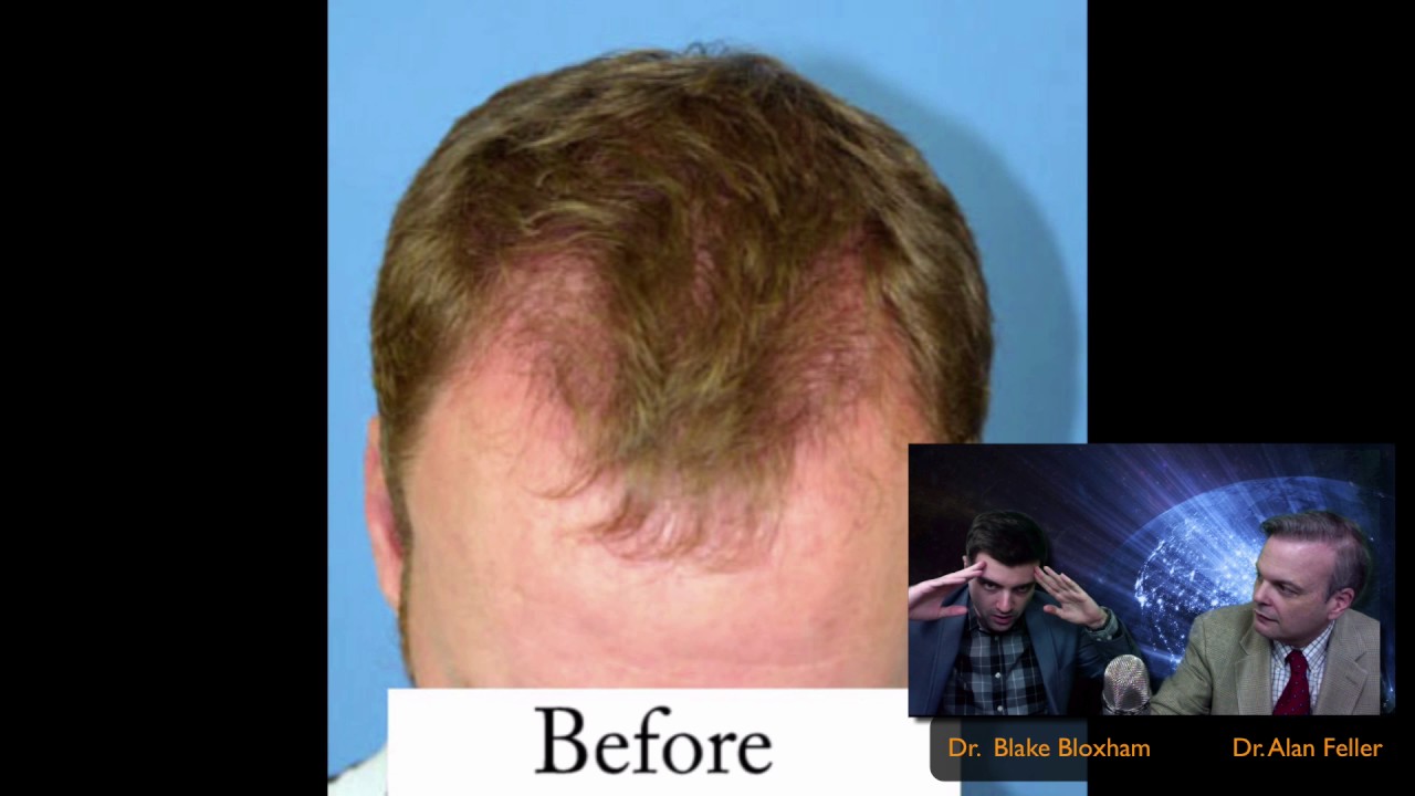 Hair Transplant Play By 3 Feller And Bloxham Great Neck Hair Transplant Play By 3 Feller And Bloxham Great Neck Long Island Ny