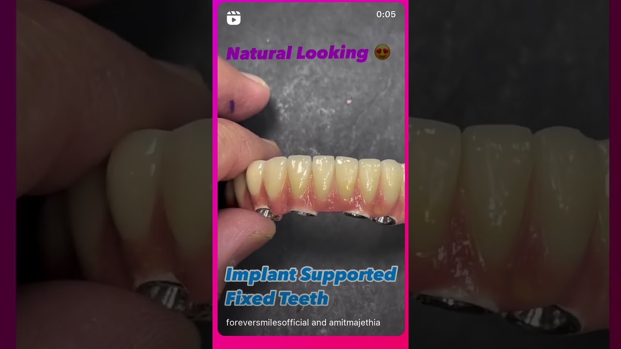 Dental Implants in Mumbai..Full Mouth Fixed Dental Implants  by Dr.Amit Majethia at Forever Smiles