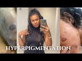 Night skincare dtaill focus hyperpigmentation