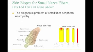 Small Fiber Neuropathy in Fribromyalgia Presentation by Todd Levine MD    Corinthian Reference Lab