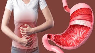 Gastritis: Causes And Treatment