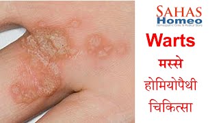 Best Treatment for Warts, मस्सो का पूर्ण इलाज