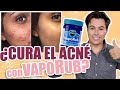 Vicks VapoRub Para El Acné?| Yasmany