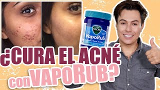 VapoRub for Acne: The Viral Remedy You Might NOT Want to Try…